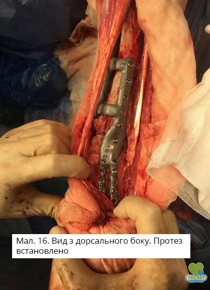 Вид з дорсального боку. Протез встановлено