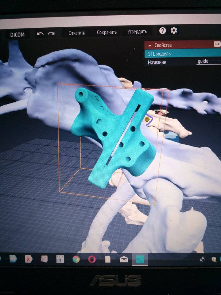 3D модель импланта