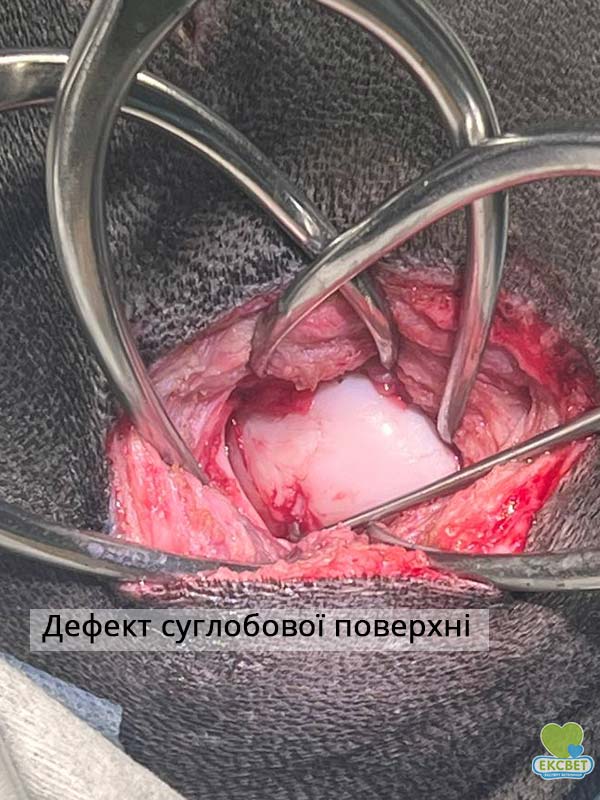 Розсікаючий остеохондрит - дефект суглобової поверхні, інтраопераційне фото