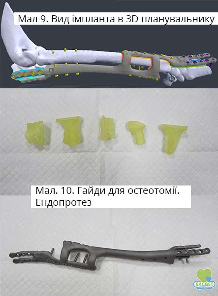 Вид імпланта в 3D планувальнику. . Гайди для остеотомії. Ендопротез