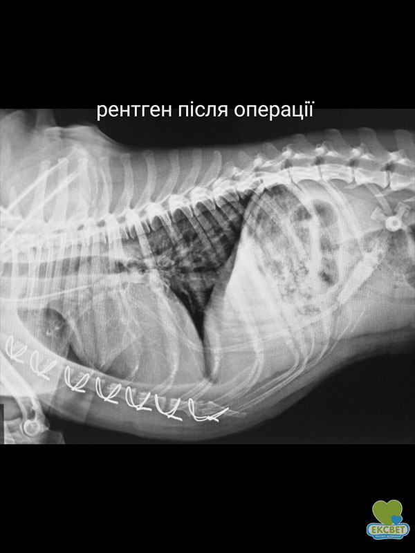 Рентген відразу після операції з вилучення тимоми