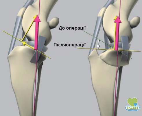 Принцип TPLO.