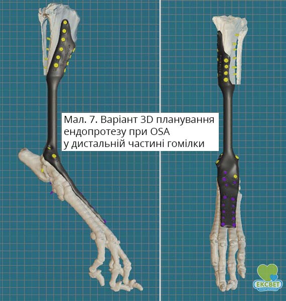 Варіант 3D планування ендопротезу при OSA у дистальній частині гомілки