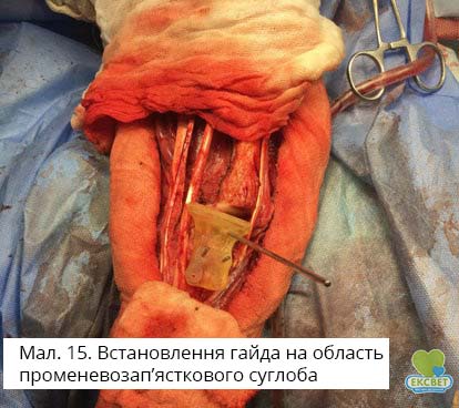 Встановлення гайда на область променевозап&rsquo;ясткового суглоба