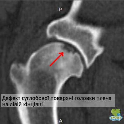 Дефект суглобової поверхні головки плечової кістки пр розсікаючому остеохондриті у собаки
